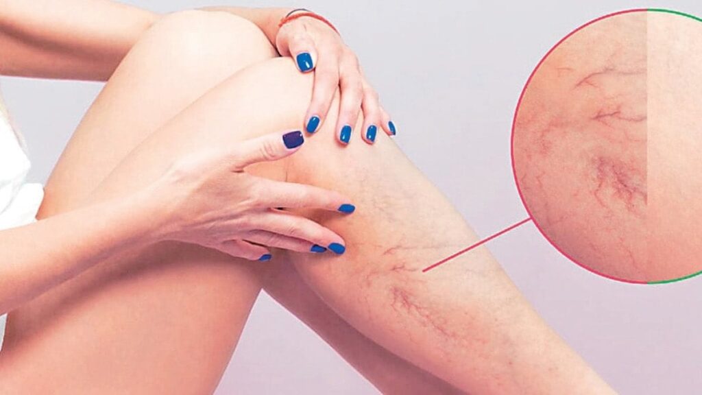 Varis vücutta ‘Pıhtı’ riskini artırabilir