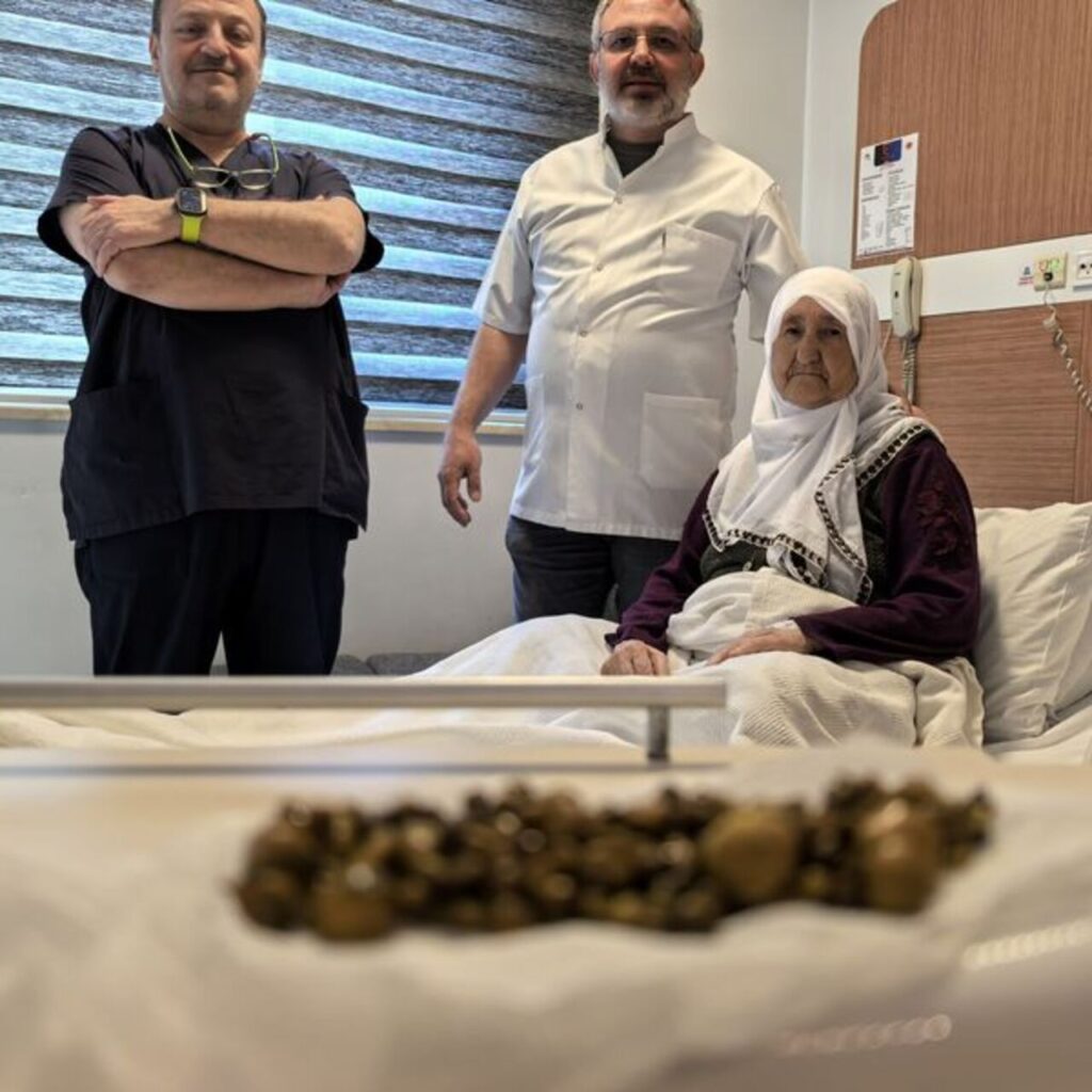 77 yaşındaki kadının safra kesesinden 213 tane taş çıkarıldı