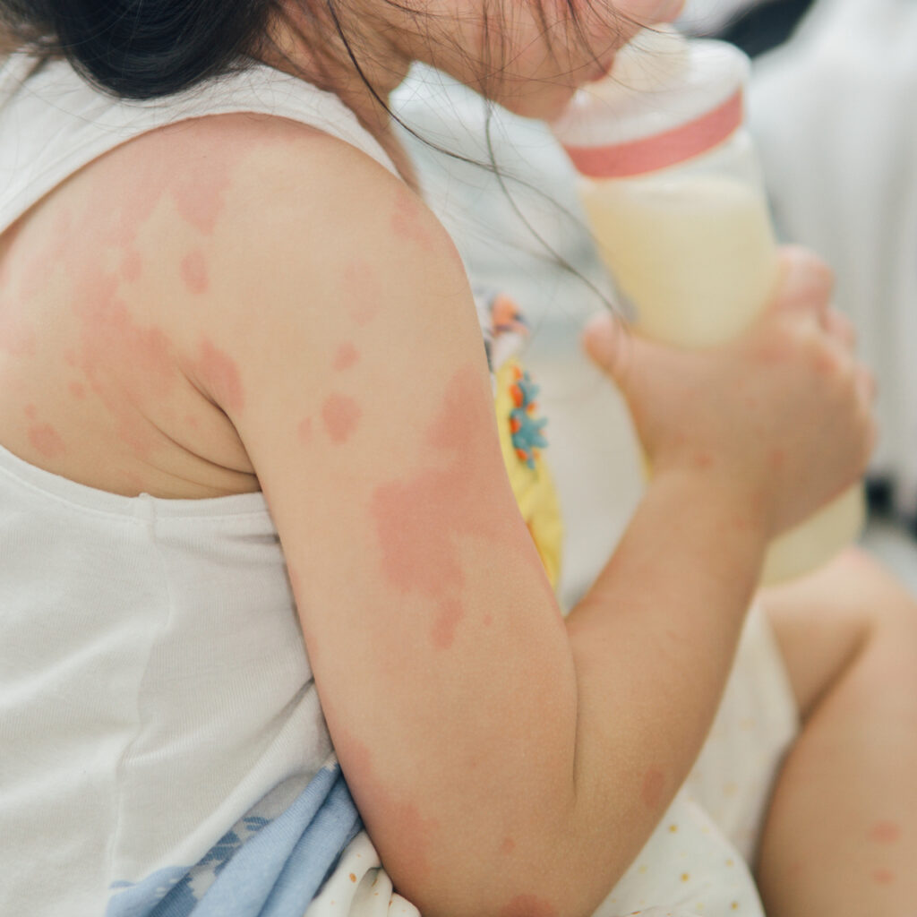 Bebeklerde ve çocuklarda alerji! Neleri yanlış biliyoruz?