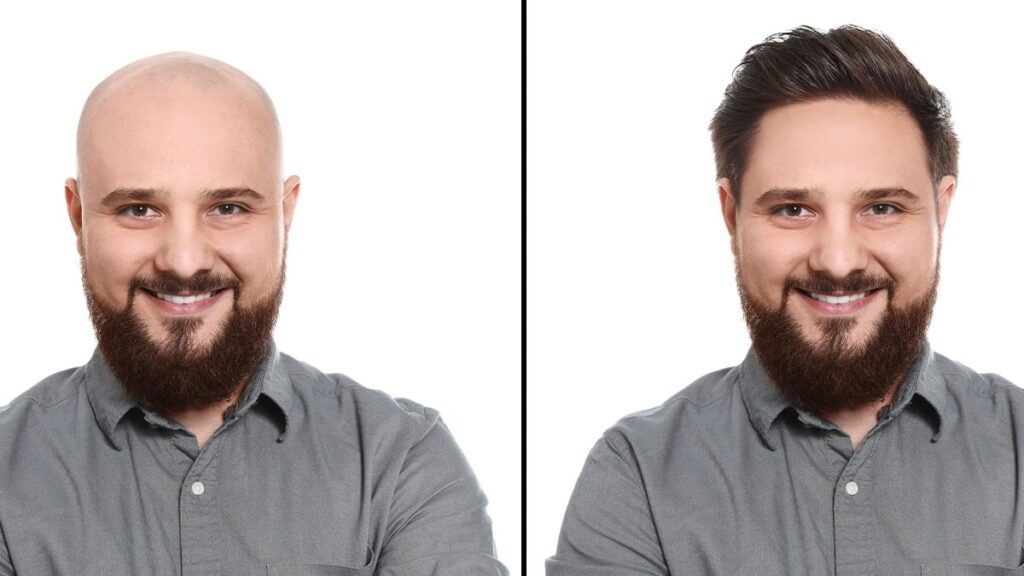 Kellik tedavisinde çığır açan çözüm: Saç büyümesini yüzde 539 artırıyor