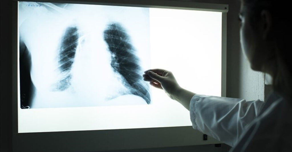 3 haftayı aşan öksürük ve kilo kaybına dikkat!