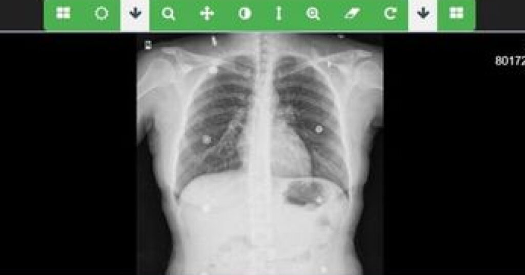 Sağlık Bakanlığı, ‘Akciğer me Sistemi’ni hayata geçirdi