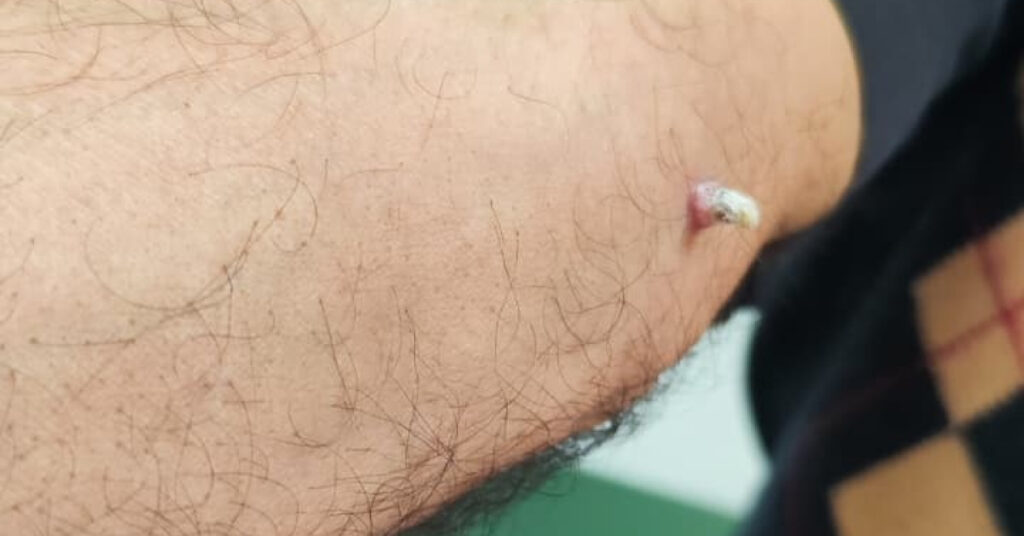 Kolundaki yara için gitti, kanser olduğunu öğrendi