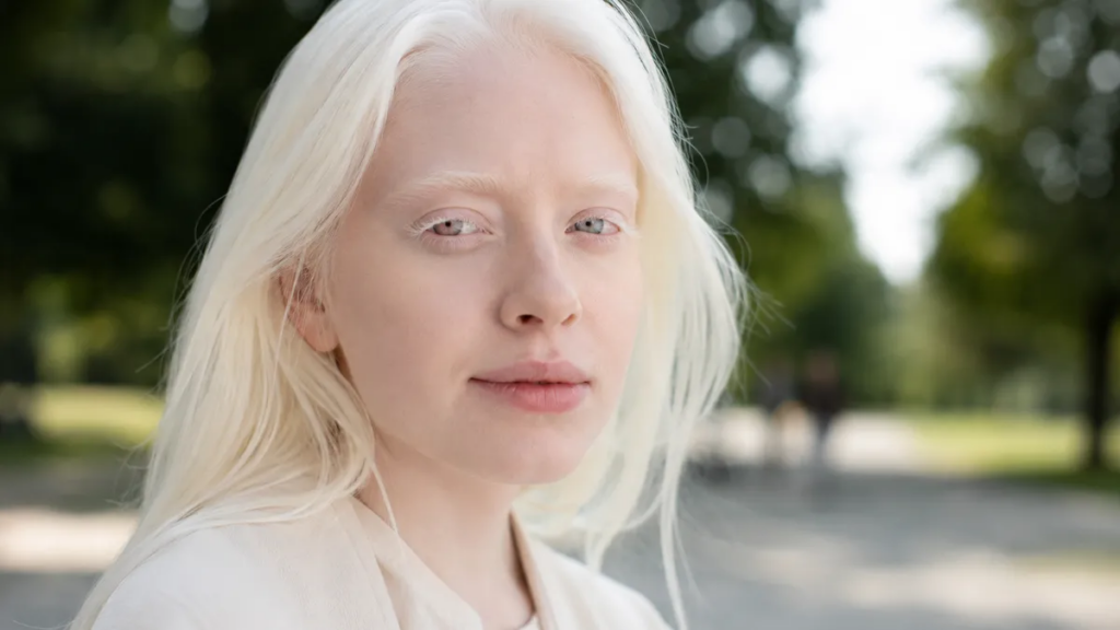 Albino nedir, neden olur? Albinizm türleri, belirtileri ve özellikleri